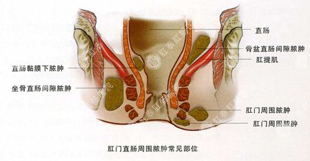 福州肛门红肿会引起什么危害？